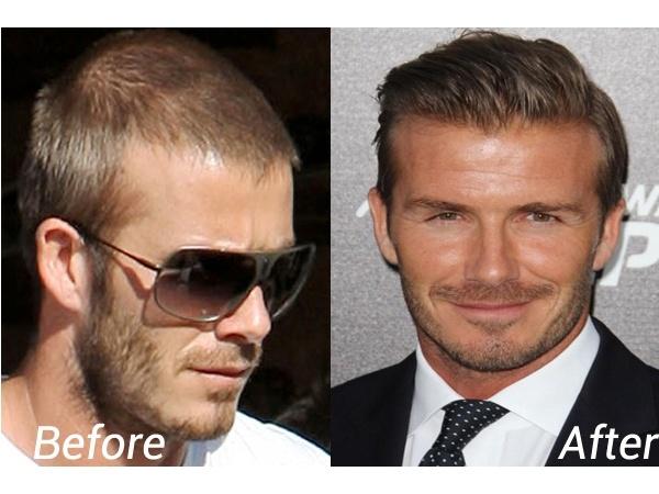 Celebrities Who Fought Hair Loss with Hair Transplantion