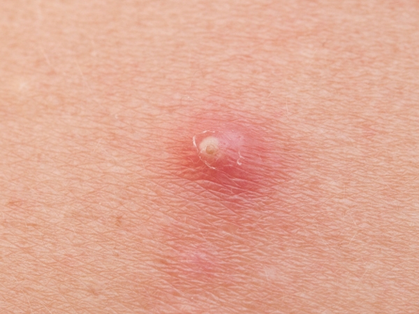 Common Skin Infections in Summer