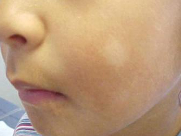 White Patches On Face Vitamin Deficiency