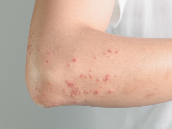 Hives: The Severely Itchy Red Rash | Healthy Living