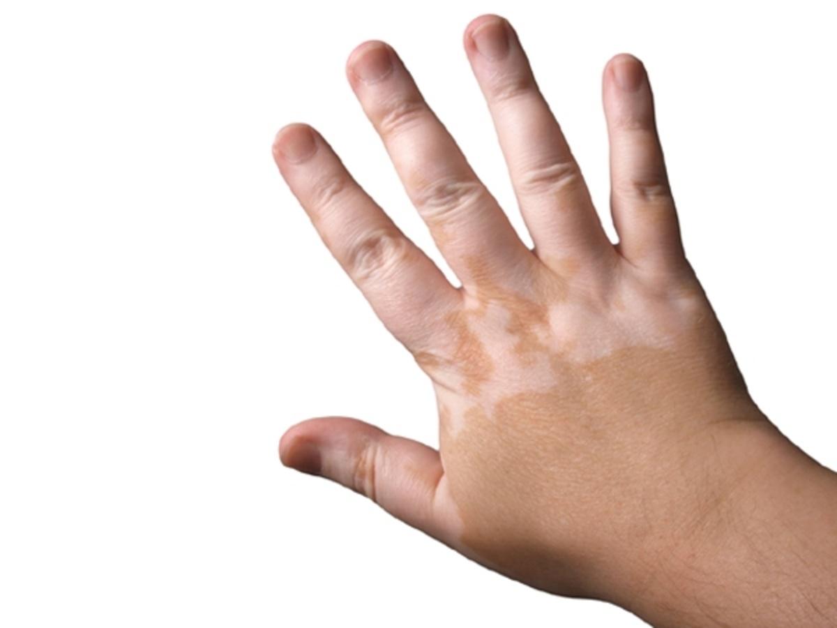 Reasons For White Skin Patches In Children Healthy Living