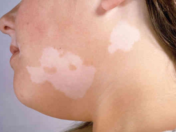 Reasons For White Skin Patches In Children Healthy Living