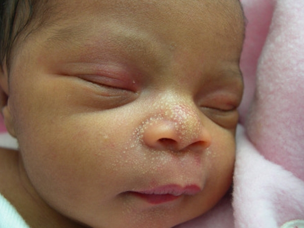 Skin Problems In Newborns