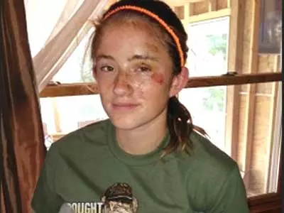 12-year-old Michigan Girl survives bear attack