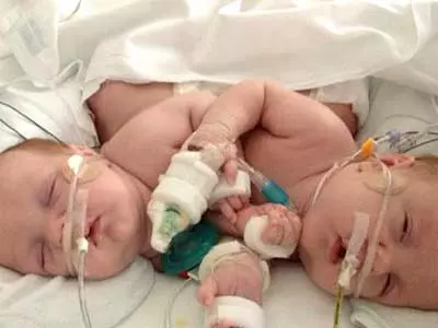 Dallas: Conjoined twins successfully separated
